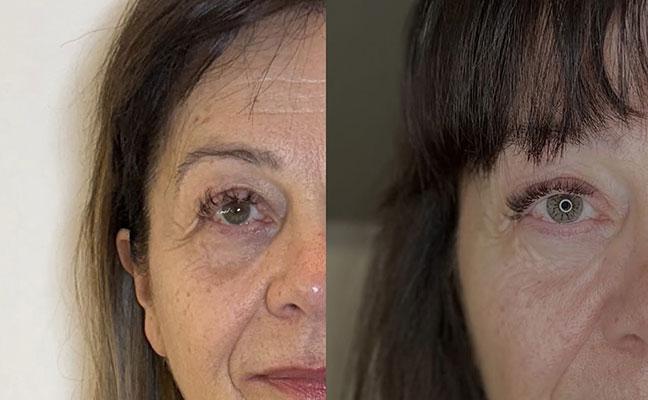 HIFU visage et corps