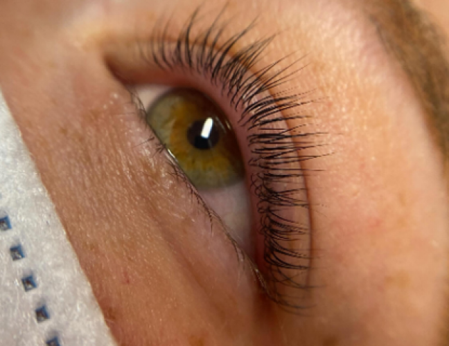 La cryolipolyse La cryolipolyse