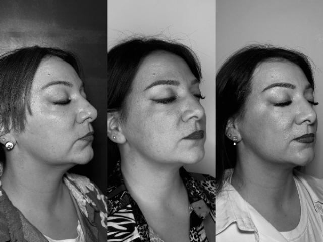 AVANT/APRÈS lifting hifu du bas du visage - résultats après 8 mois