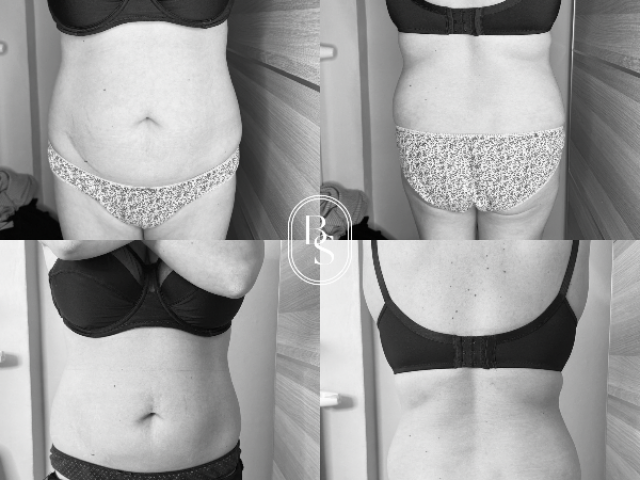 AVANT / APRÈS cryolipolyse : passez d’une taille 40 à 38 sans chirurgie ! 