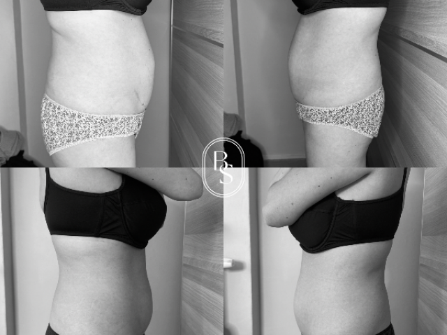 AVANT / APRÈS cryolipolyse : passez d’une taille 40 à 38 sans chirurgie ! 