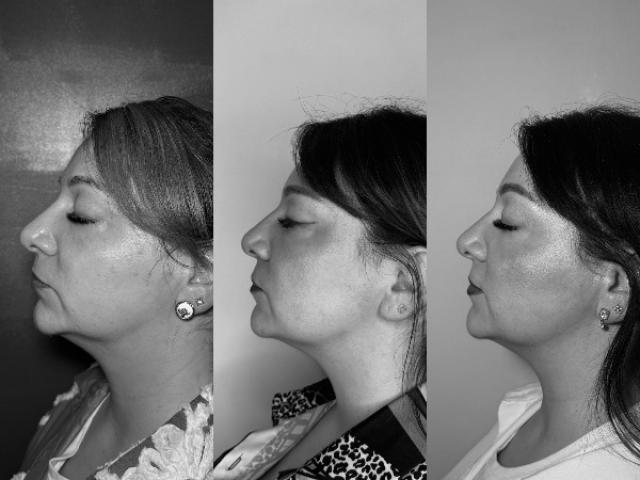 AVANT/APRÈS lifting hifu du bas du visage - résultats après 8 mois