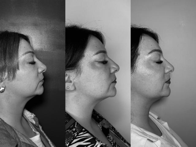 AVANT/APRÈS lifting hifu du bas du visage - résultats après 8 mois