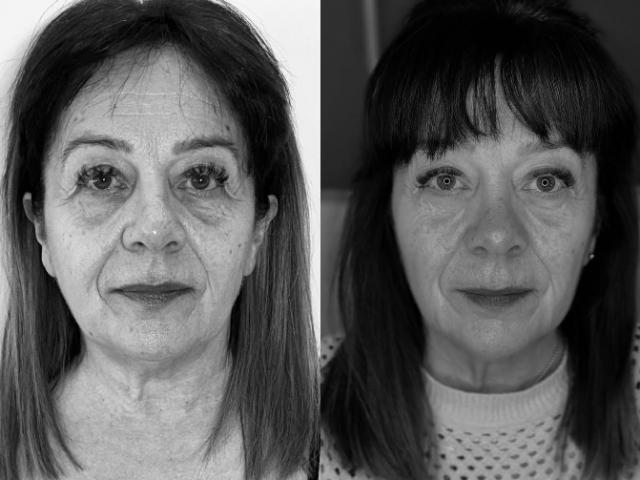 AVANT/APRÈS Hifu sur l’entièreté du visage - résultat après 6 mois
