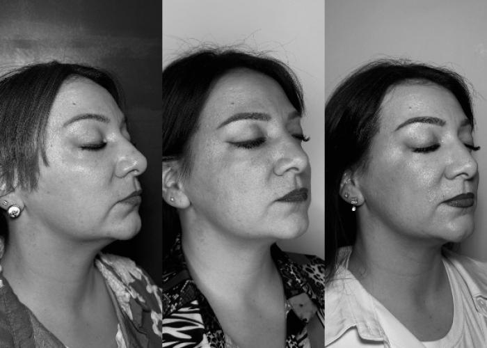 AVANT/APRÈS lifting hifu du bas du visage - résultats après 8 mois