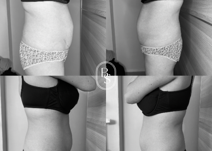 AVANT / APRÈS cryolipolyse : passez d’une taille 40 à 38 sans chirurgie ! 