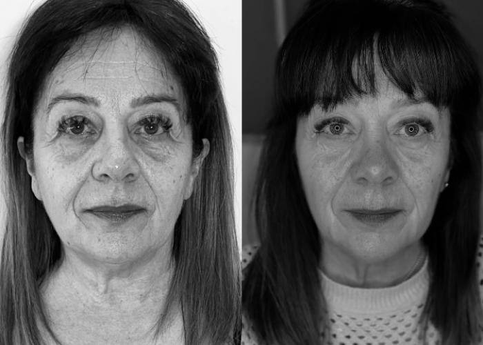 AVANT/APRÈS Hifu sur l’entièreté du visage - résultat après 6 mois